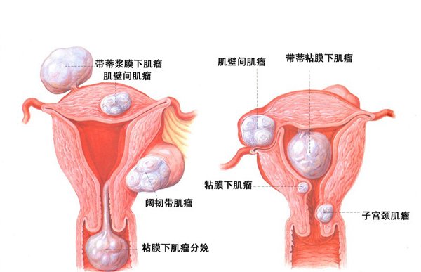 子宫肌瘤的分类有哪些种？